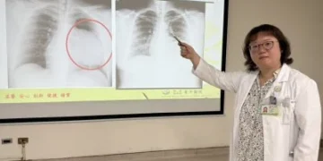 社會新鮮人求職健檢驚見15公分巨大腫瘤 胸腔鏡手術發現竟是畸胎瘤